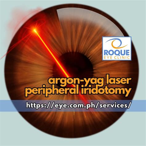 yag laser huddersfield|YAG laser iridotomy Specialists in Huddersfield .